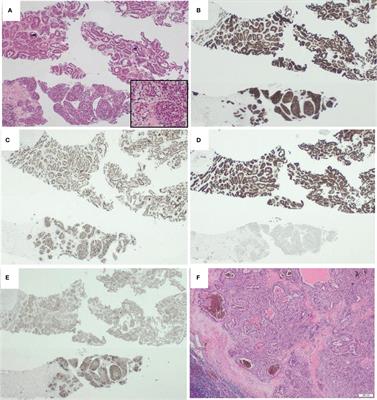 Case Report: Disease progression of renal cell carcinoma containing a novel putative pathogenic KAT6A::NRG1 fusion on Ipilimumab- Nivolumab immunotherapy. A case study and review of the literature